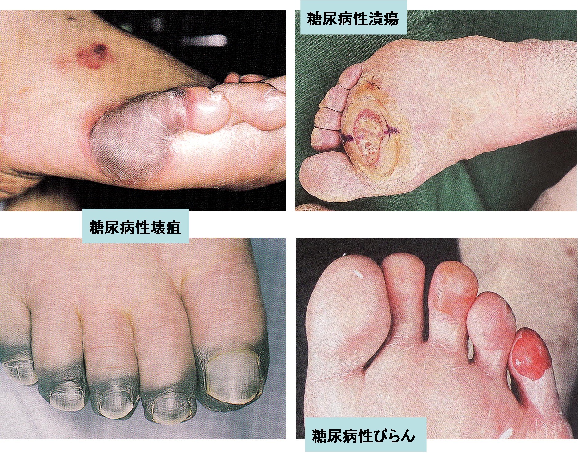足 壊死 症状 👆糖尿病 初期 足の潰瘍(かいよう)・足の壊疽(えそ)