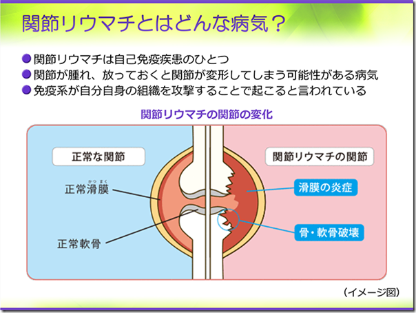 4-関節リウマチ01_688号