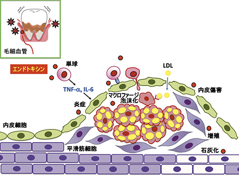 歯周病は動脈硬化に対する新たな危険因子 | 汐田総合病院